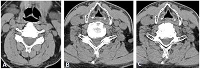 Conversion Paralysis After Cervical Surgery: A Case Report and Literature Review